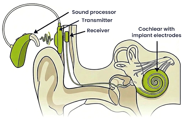 cochlear implant